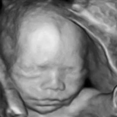 What Is a 3D Ultrasound? | Parents