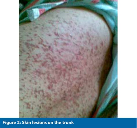 Figure 2 from Stevens Johnson Syndrome - Toxic Epidermal Necrolysis Induced by A Combination of ...