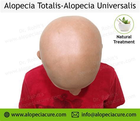 Alopecia Universalis