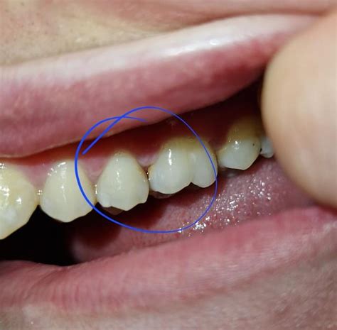 Discoloration between 2 teeth : r/DentalHygiene