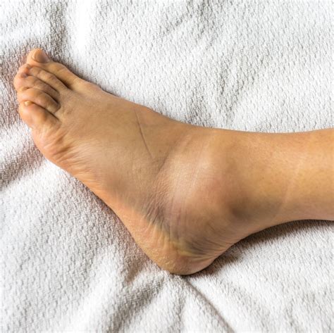 Doctors Explain 12 Reasons You May Be Dealing With Swollen Ankles ...