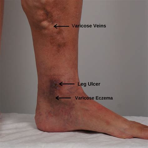 What is the Best Way to Heal a Leg Ulcer? | The VeinCare Centre