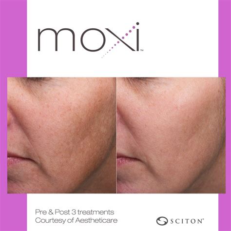 MOXI™ Laser Skin Rejuvenation Springfield, Massachusetts | Dr. Glen Brooks