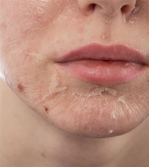 Skin Peeling: Causes, Symptoms, And How To Reduce It