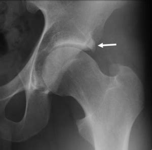 Femoroacetabular Impingement (FAI) - Hip Arthroscopy Australia