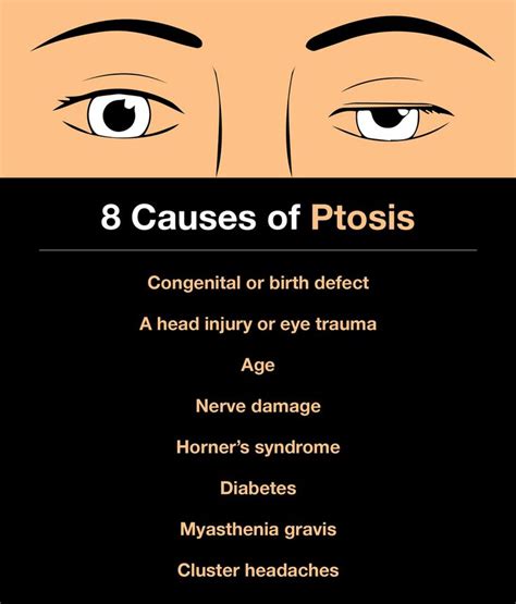 8 Causes of Ptosis and What You Can Do About It | Cluster headaches, Myasthenia gravis, What you ...