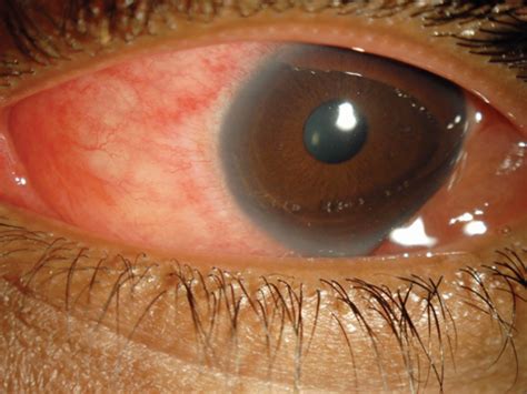 Adenovirus Keratitis