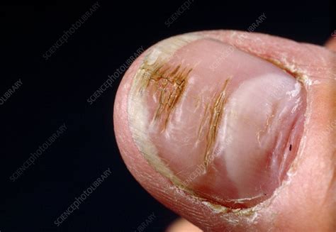 Nail dystrophy - Stock Image - C002/5267 - Science Photo Library