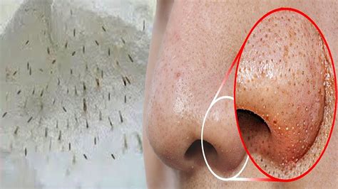 Do THIS to Remove Blackheads From Your Nose ! How to remove blackheads naturally at home! - YouTube