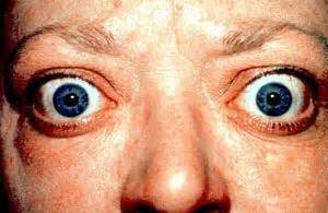 Exophthalmos: Causes, symptoms, and treatment