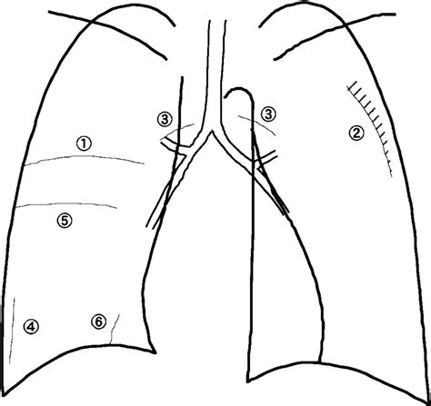 Schematic drawing of fissure lines. 1: Minor fissure. 2: Superolateral... | Download Scientific ...