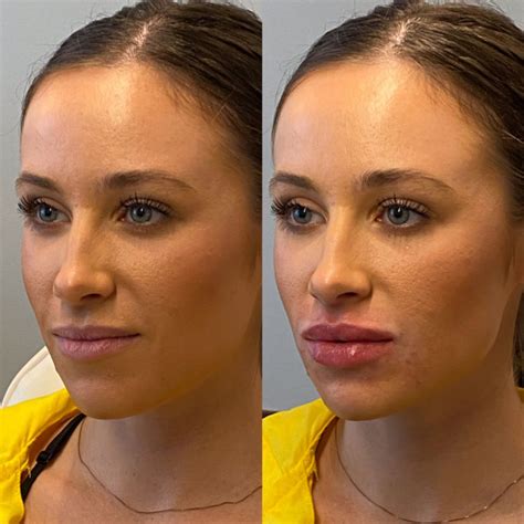 The Ultimate Guide to Lip Flip: Before and After Results - Flash Uganda ...