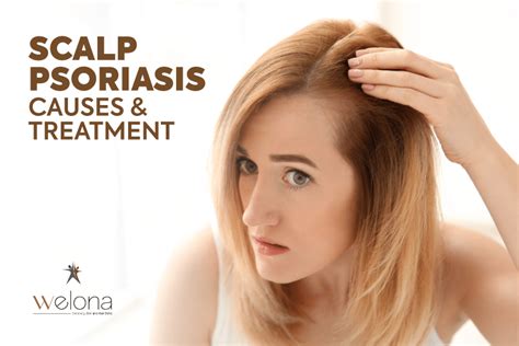 Update 71+ scalp psoriasis hair loss super hot - in.eteachers