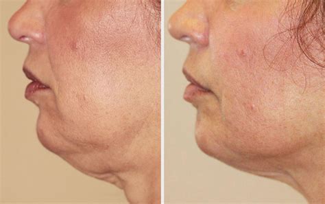 Is Radio Frequency Skin Tightening Safe in Cheshire? - shoreshim