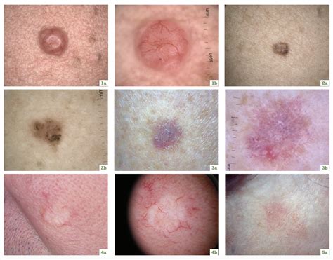 Increase your confidence in using dermatoscopy to diagnose non-melanoma skin cancers | New ...