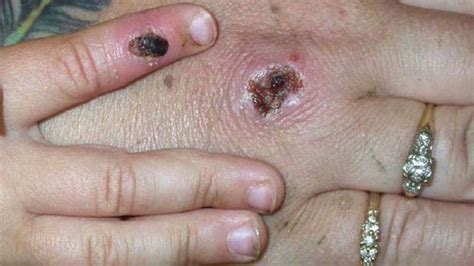 Monkeypox? British health worker infected with rare disease | CBC News