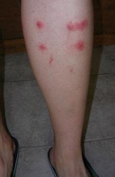 Do Gnats bite? Symptoms, Treatments and Pictures | Gnat bites, Gnats