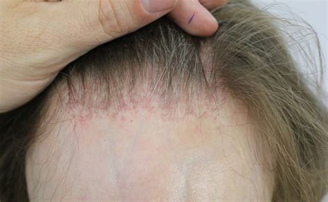 Hair Transplantation in Frontal Fibrosing Alopecia — Donovan Hair Clinic