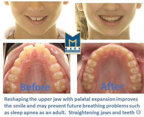 Before and After - Mark McDonough DMD Orthodontist | Pennington NJ