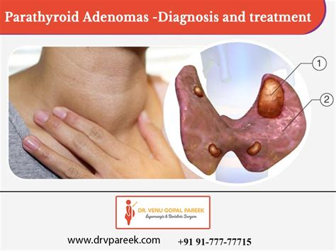 Parathyroid Adenomas Diagnosis And Treatment