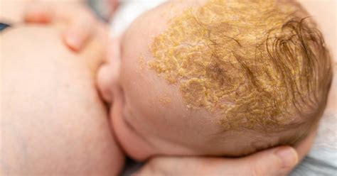 Cradle Cap vs. Eczema: Seborrheic and Atopic Dermatitis