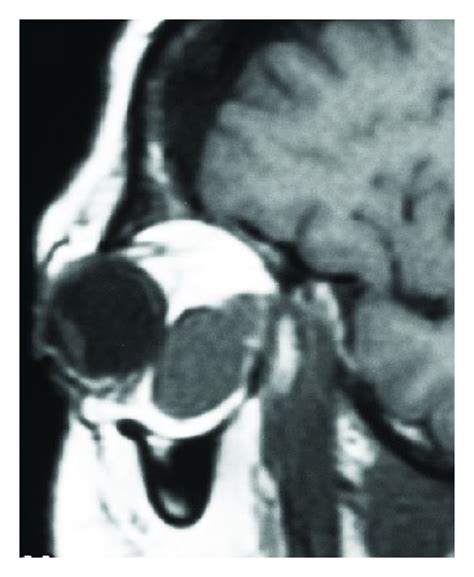 Initial inferior fornix conjunctival incision. | Download Scientific Diagram