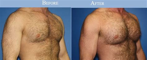 Male Plastic Surgery Procedures - Business Insider