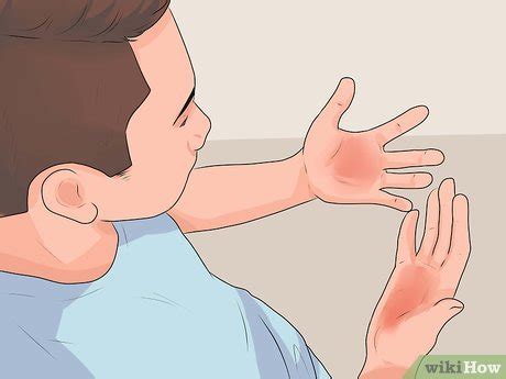 4 Ways to Treat a Hand Burn - wikiHow