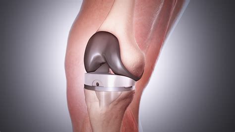 Knee Replacement Surgery: The most popular orthopedic procedure