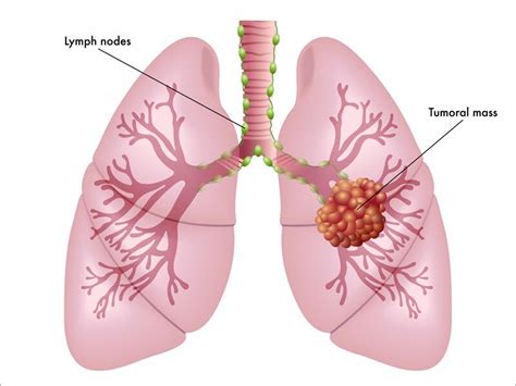 Lung Cancer Community: 'This Is Our Fight'