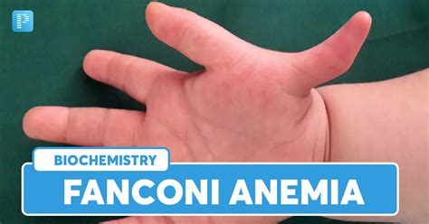 Fanconi Anemia: Symptoms, Causes and Treatment