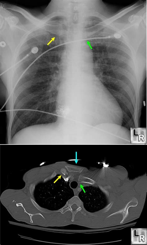 LearningRadiology.com - Sternoclavicular dislocation,posterior,medial ...