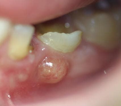 Category:Tooth abscess - Wikimedia Commons