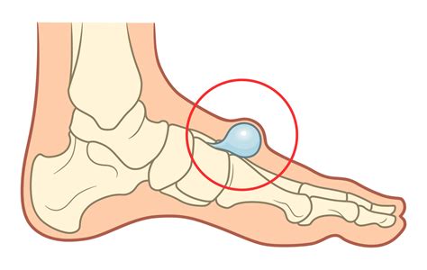 Ganglion - so verschwindet es - Lebensfreude aktuell