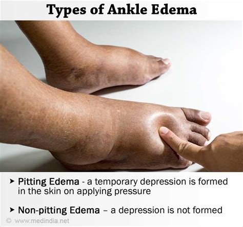 Ankle Edema / Ankle Swelling - Causes FAQs