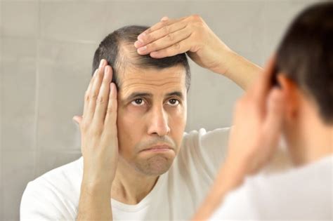 Androgenic Alopecia: Symptoms, Causes and Treatment - Step To Health