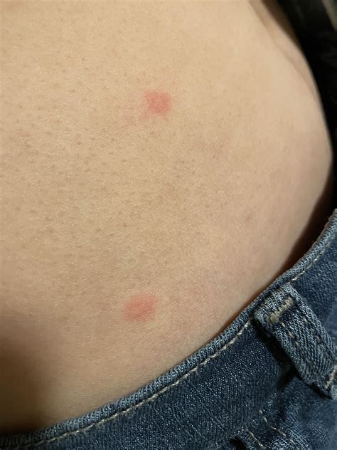 are these stress hives or bed bug bites? : r/bugbite