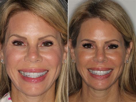 See Our Patients Before and After Lumineers - Hinsdale Dentistry