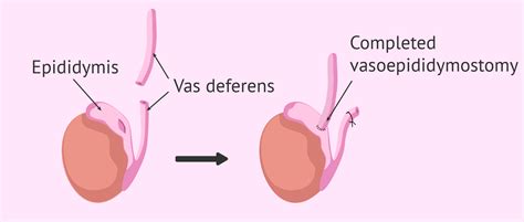 Vasectomy Reversal - Chin Chong Min Urology & Robotic Surgery Centre