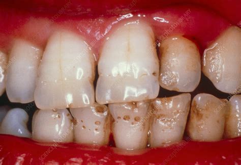 Enamel Hypoplasia