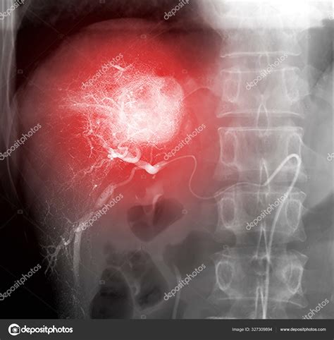 Ray Image Toce Chemoembolization Procedure Allows Dose Chemotherapy Drugs Administered — Stock ...