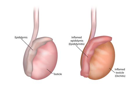 Epididymitis And Orchitis - Harvard Health