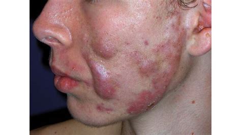 Acne Conglobata: Symptoms, Causes, Treatment, Prevention