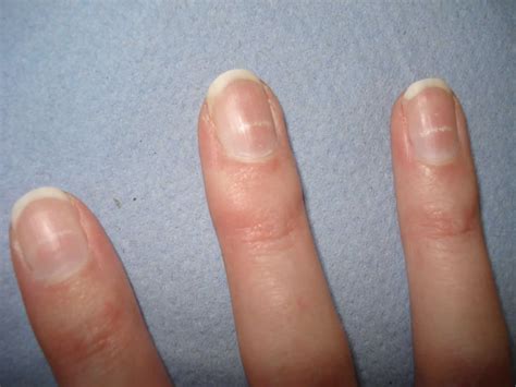 Lunula definition, lunula function & nail problems