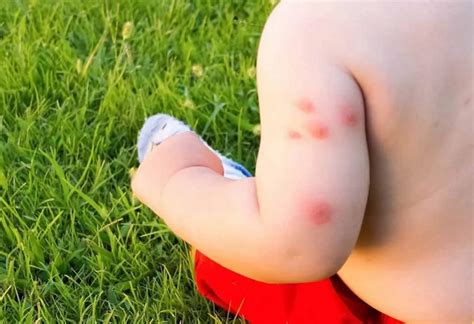 Bed bug bites on baby: Symptoms and Natural way of prevention