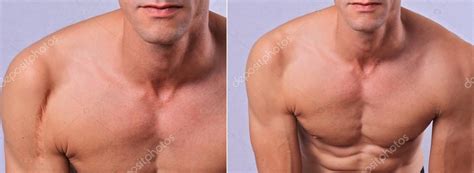 Laser scar removal before and after. Attractive Man with scar on his shoulder Stock Photo by ...