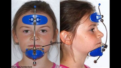 Image result for reverse pull headgear | Face mask, Orthodontics, Headgear