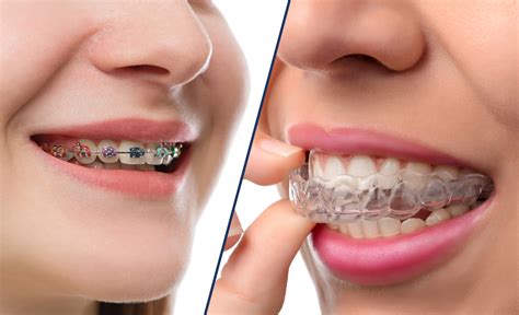 Braces vs. Invisalign | Leber Orthodontics | Tucson Braces