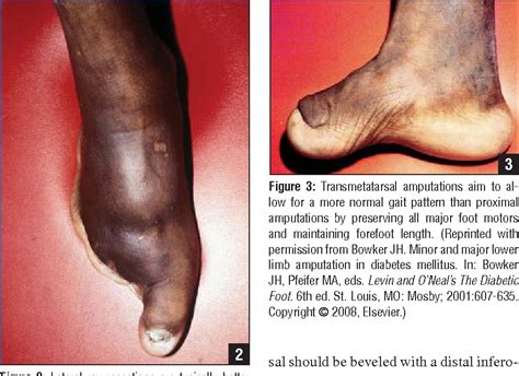 Diabetic Foot Ulcer Amputation