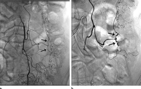 Empiric Embolization of a Diverticular Bleed with CT Angiographic ...